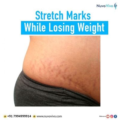 If You Lose Weight Will Your Stretch Marks Go Away, and Can You Turn Them Into a Map of the Stars?