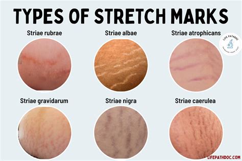 What Do Guys Think About Stretch Marks: A Symbol of Growth or Just Skin Deep?