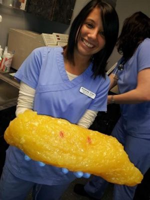 What Does 40lbs of Fat Look Like? And Why Does It Remind Me of a Bag of Flour?